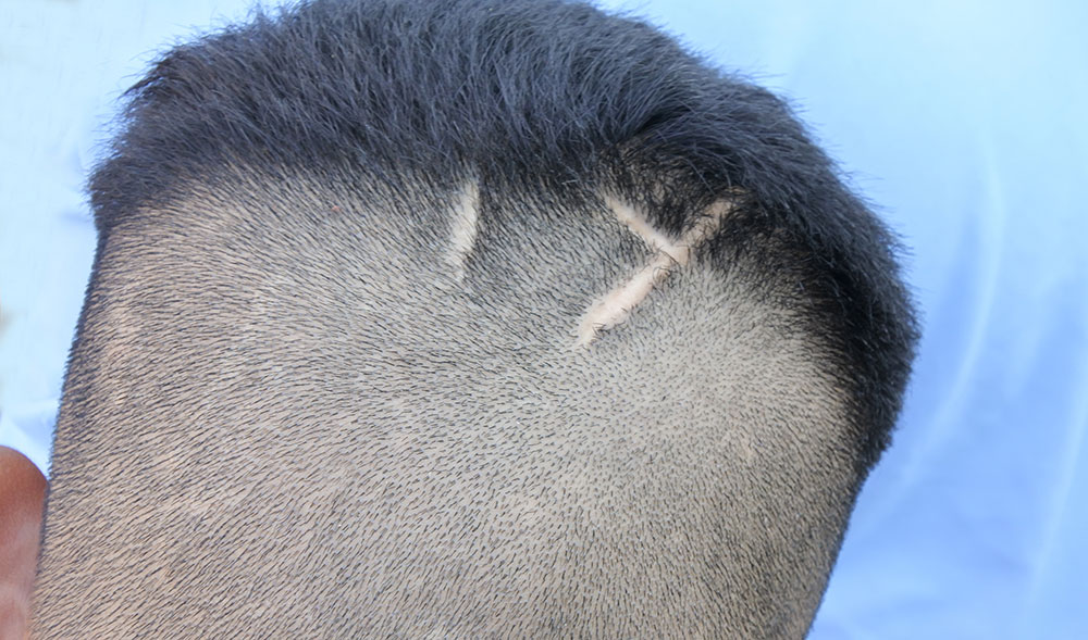 Hair Transplant for Scarred Areas: Is It Possible?