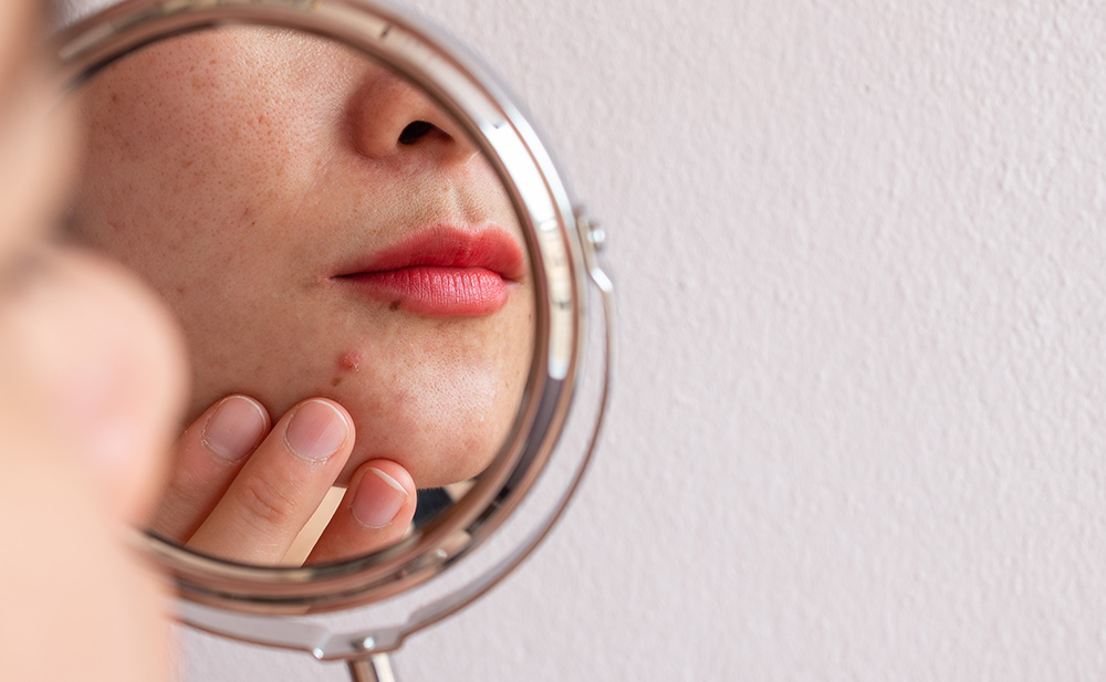 Understanding Acne: Common Types and Causes