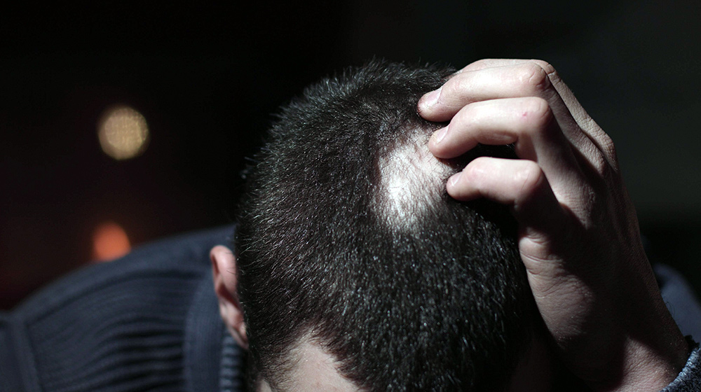 Understanding the Risk Factors of Alopecia