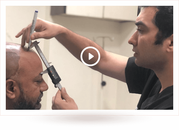 hair transplant india - Dr Malay Mehta