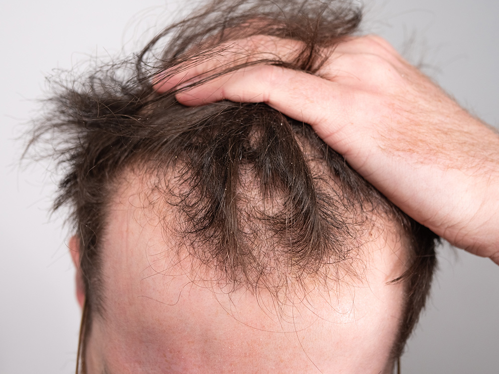 Men and Baldness: Why Baldness Occurs in Males