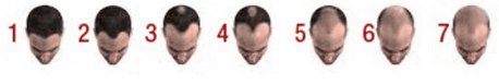 baldness level