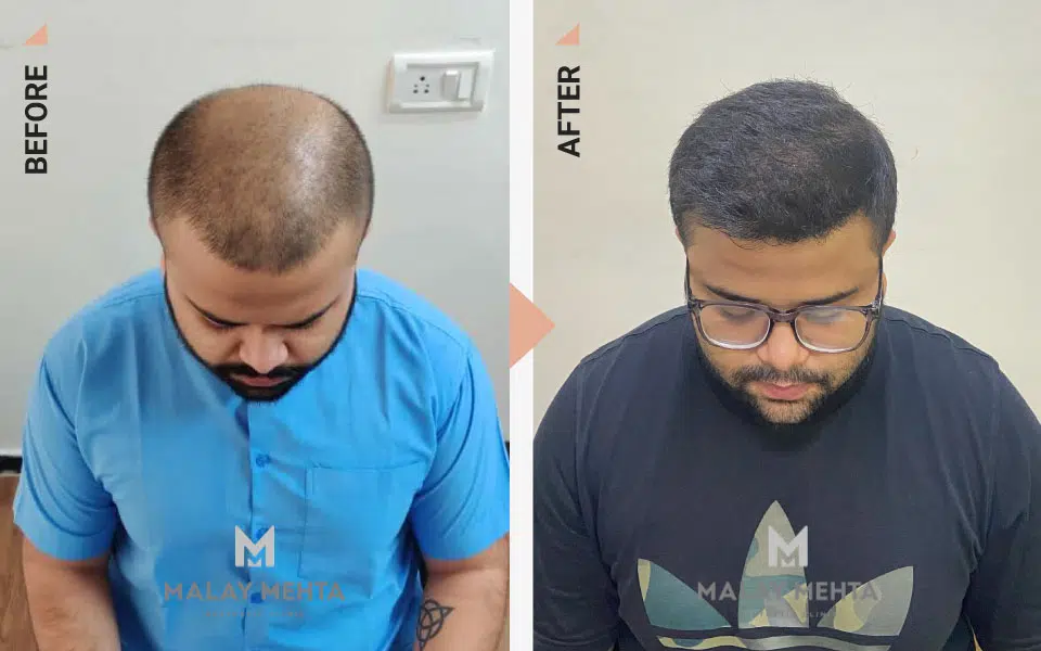 fue hair transplant before after