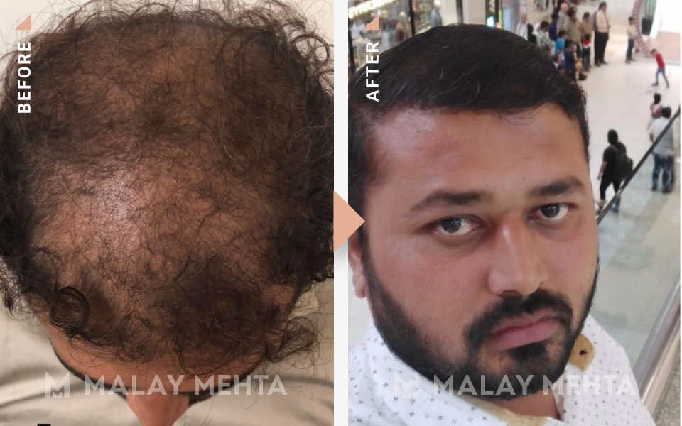 fue transplant before after