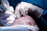 Hair Transplant Process - A Boon for Bald Issues