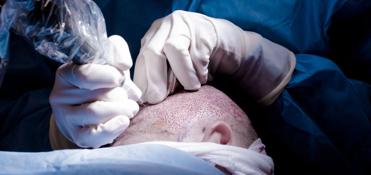 Hair Transplant Process - A Boon for Bald Issues