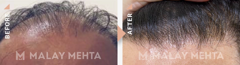 hairline reconstruction before after