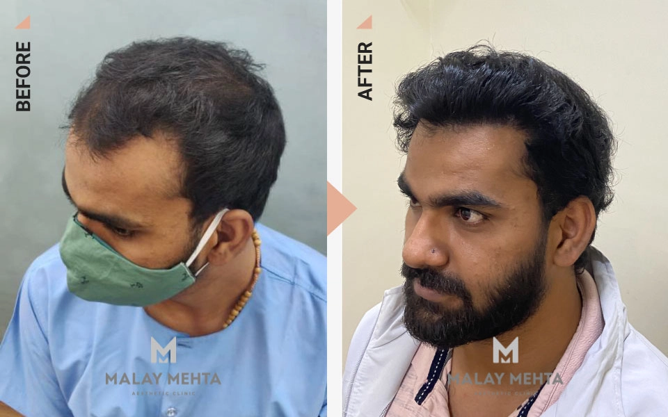 hairline reconstruction mumbai before after