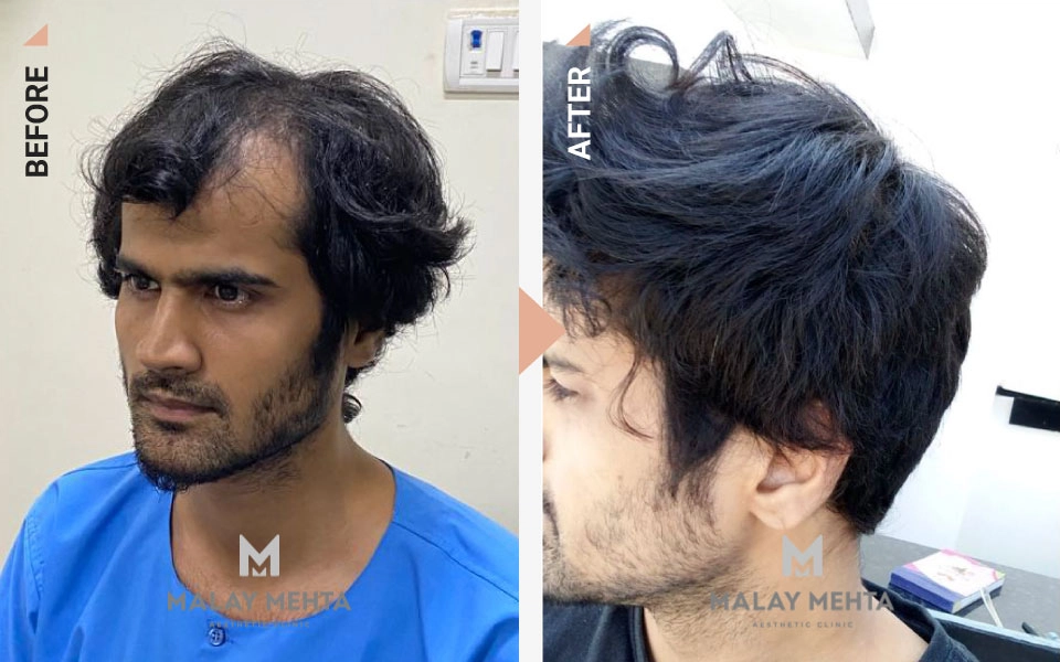 hairline reconstruction procedure mumbai