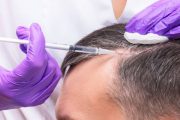 PRP Therapy for Hair and Face
