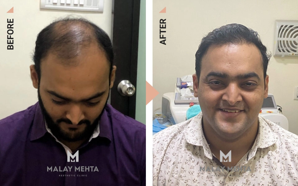 scalp micropigmentation before and after