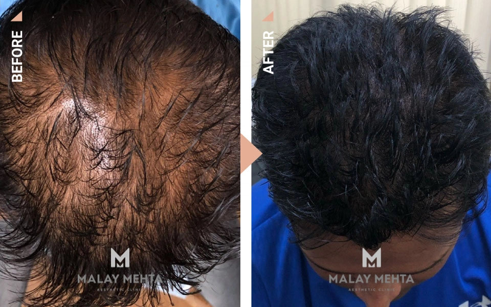 scalp micropigmentation procedure mumbai
