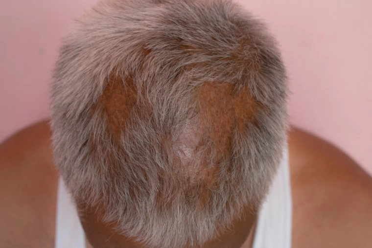 alopecia hair loss treatment mumbai