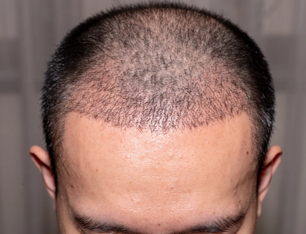 hairline reconstruction cost mumbai