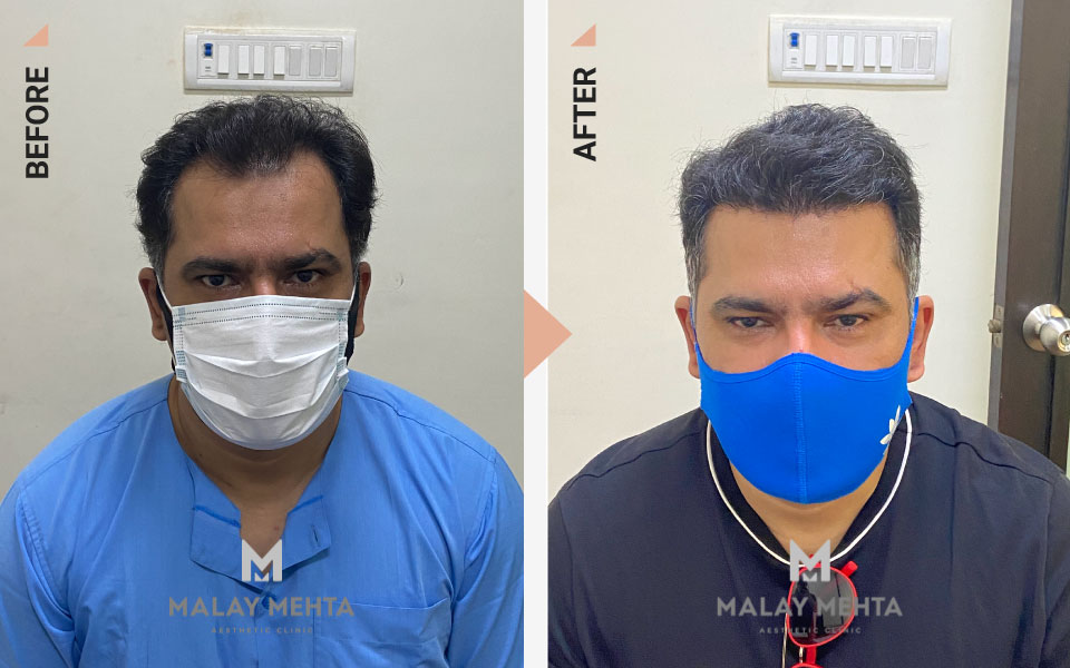 hairline reconstruction mumbai before after