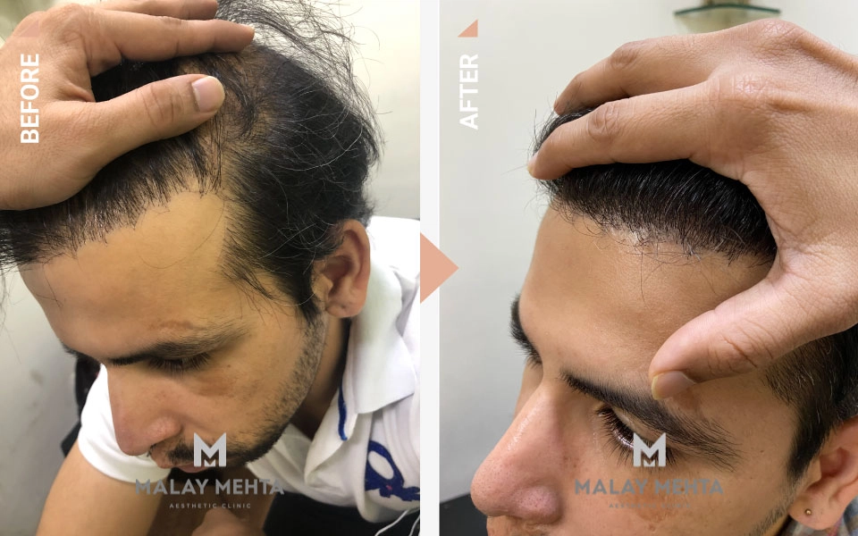 hairline reconstruction procedure mumbai before after