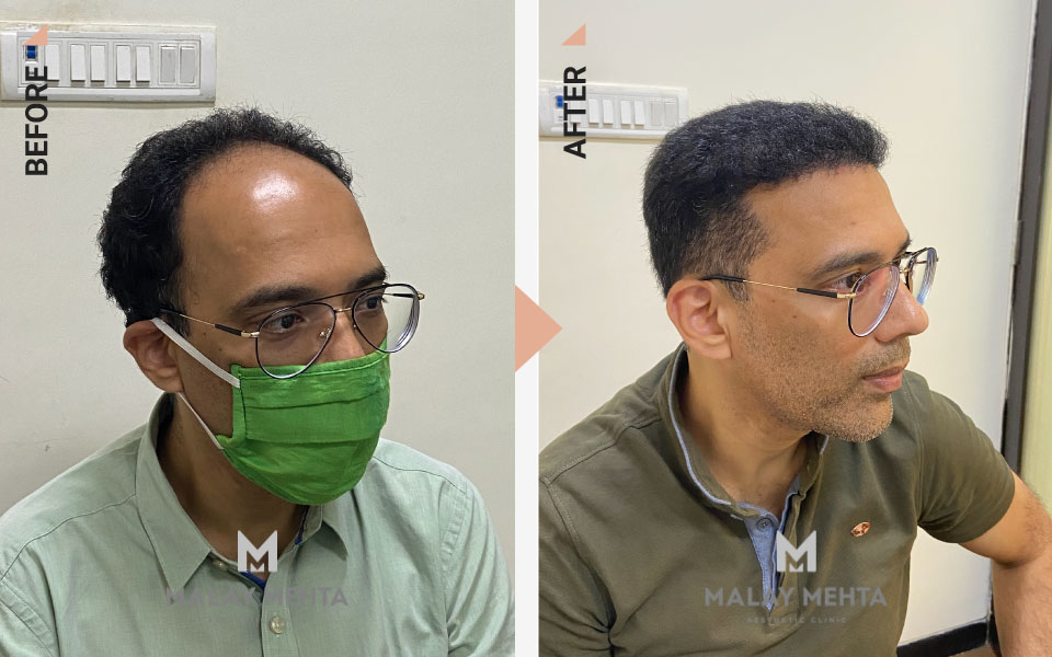 hairline reconstruction surgery cost mumbai before after