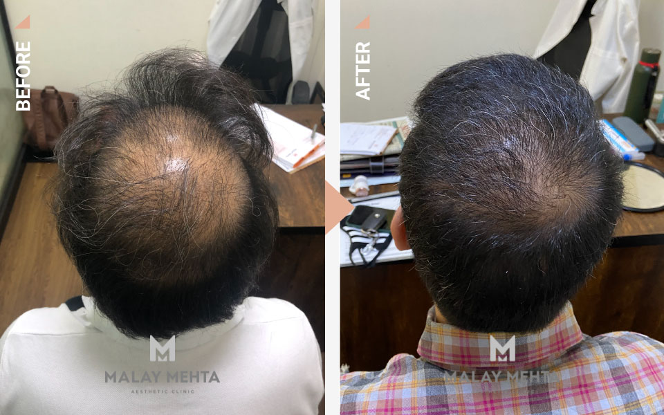 hairline reconstruction surgery mumbai before after
