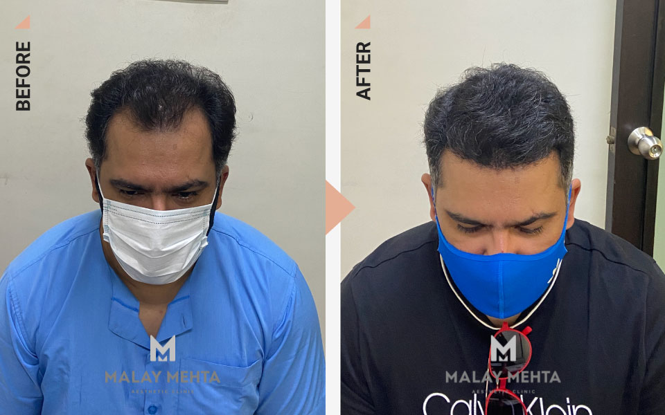 hairline reconstruction surgery mumbai before after