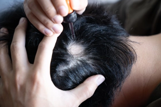 Alopecia areata treatment
