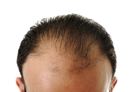 Androgenic Alopecia Treatment Mumbai