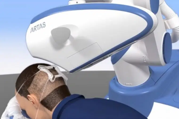 artas robotic hair transplant