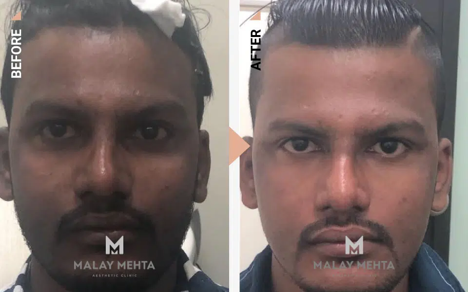 Chemical Peel Skin Whitening Before After Image Dr Malay Mehta