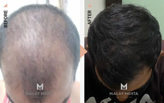 Mesotherapy Before After Image - Dr Malay Mehta