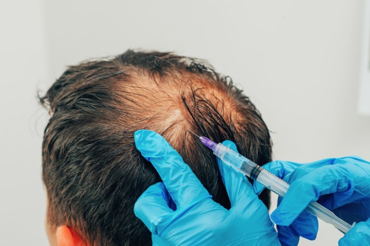 prp hair treatment success rate - Dr Malay Mehta