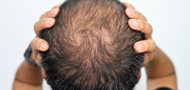 early signs of balding