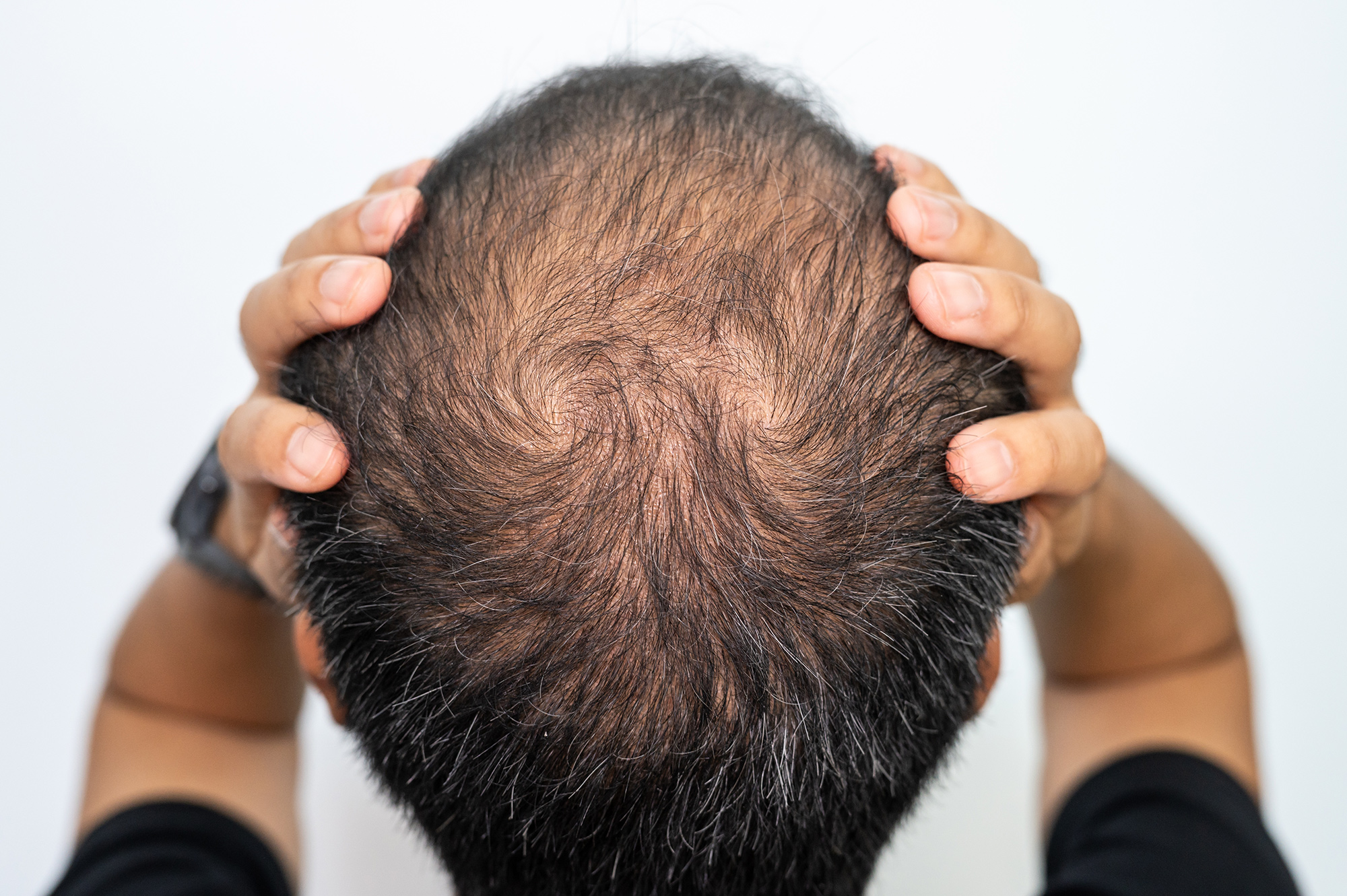 Early Signs Of Balding | Malay Mehta Aesthetics Clinic