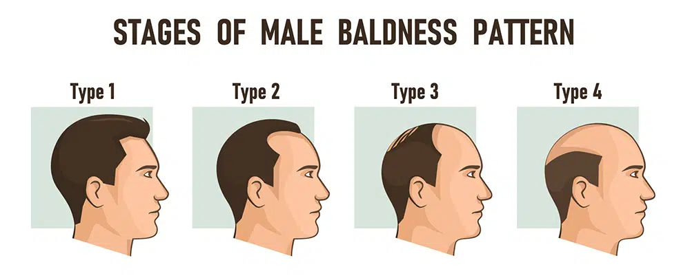 stages of male baldness pattern