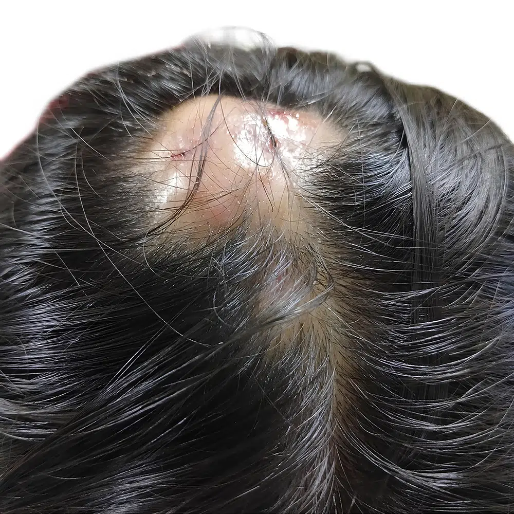 folliculitis scarringfolliculitis treatment prevent folliculitis