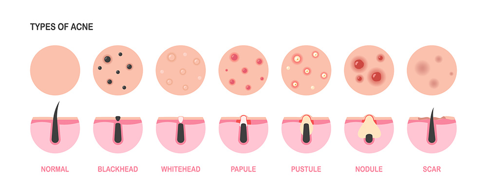 Types of Acne | What Causes Acne | Symptoms of Acne | Hormonal Acne