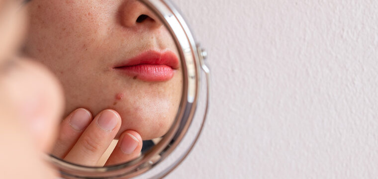 Types of Acne | Fungal Acne | Inflammatory Acne | Cystic Acne