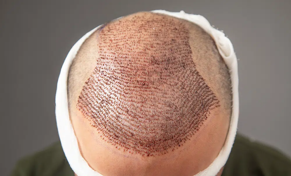 Precautions after Hair Transplant | Donor Area After Hair Transplant | Do and Don'ts After Hair Transplant