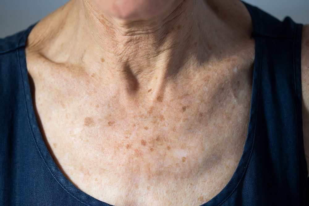 Age Spots Treatment | What Are Age Spots | How to Remove Age Spots
