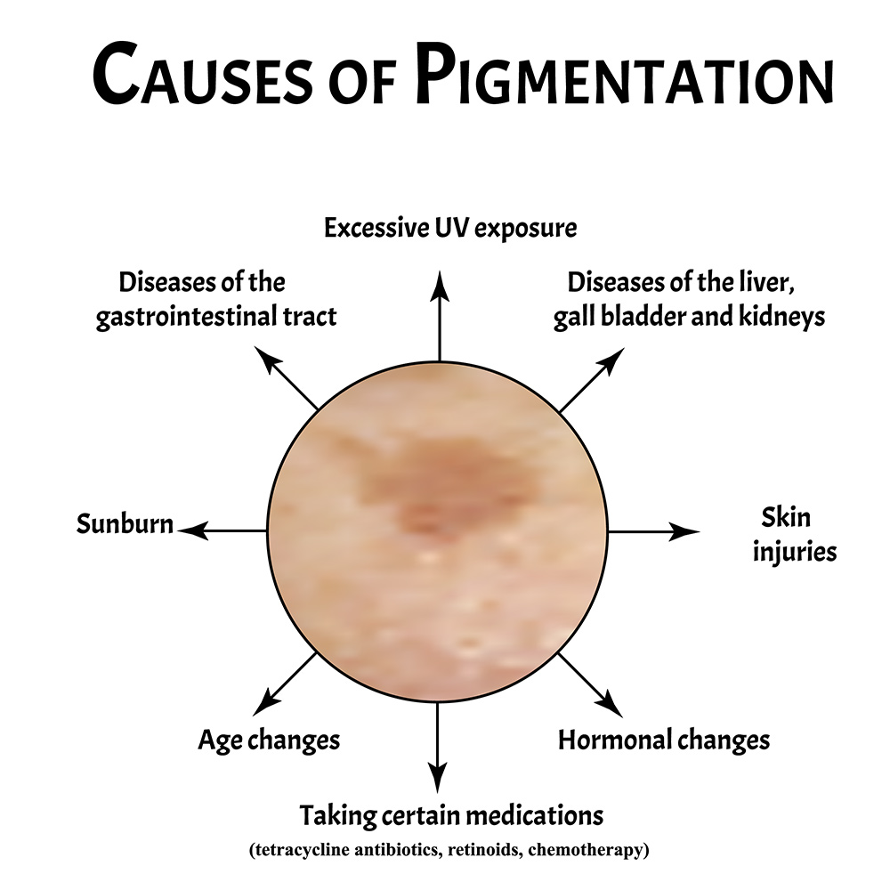 Age Spots Treatment | What Are Age Spots | How to Remove Age Spots