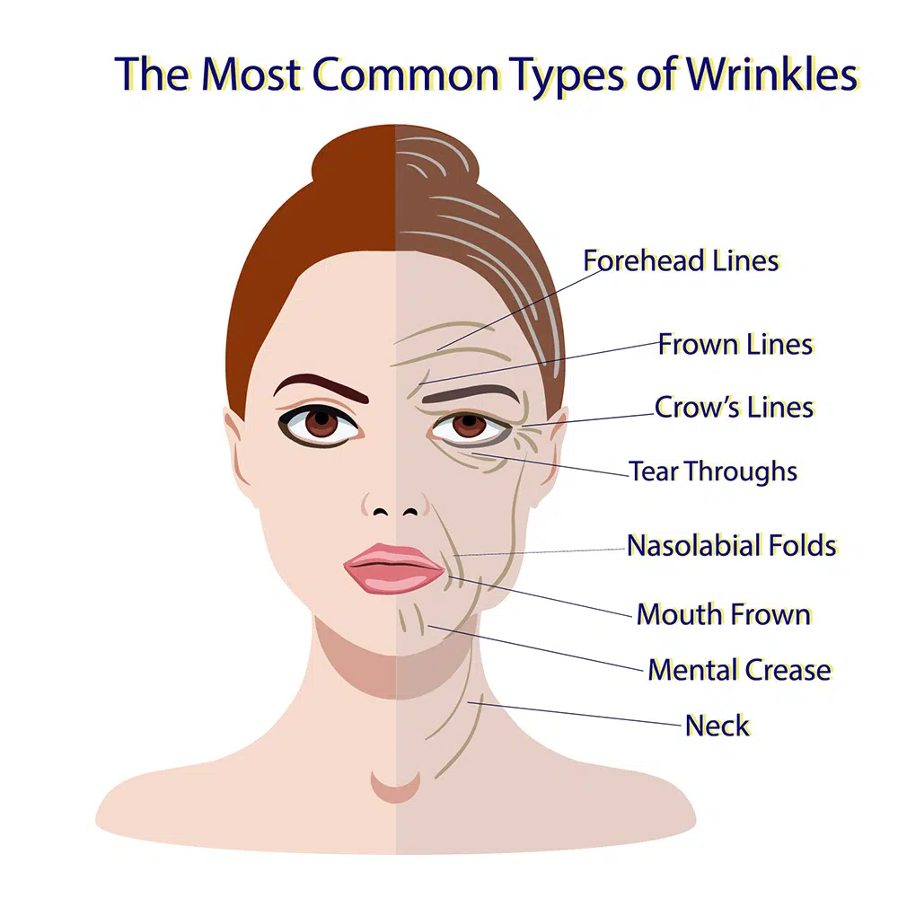 Types of Wrinkles | What Are Wrinkles | Dynamic Wrinkles