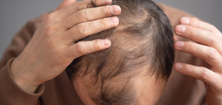 Does Creatine Cause Hair Loss | Creatine and Hair Loss