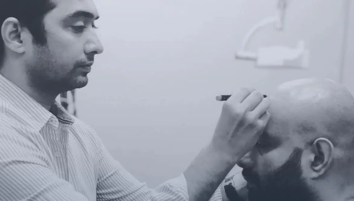 Does Smoking Cause Hair Loss | Smoking and Hair Loss | How to Stop Hair Loss Due to Smoking