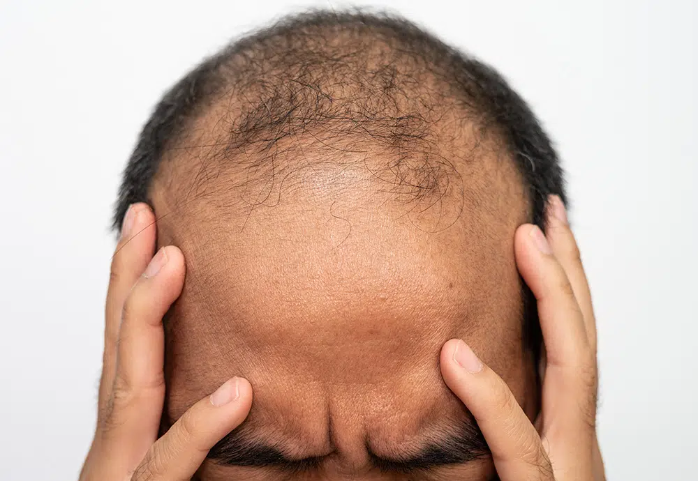 Does Smoking Cause Hair Loss | Smoking and Hair Loss | How to Stop Hair Loss Due to Smoking