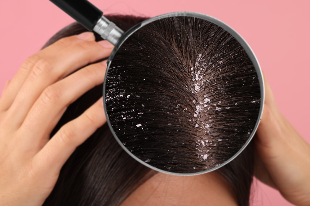 Itchy Scalp and Hair Loss | How to Get Rid of Itchy Scalp | Why is My Scalp Itchy