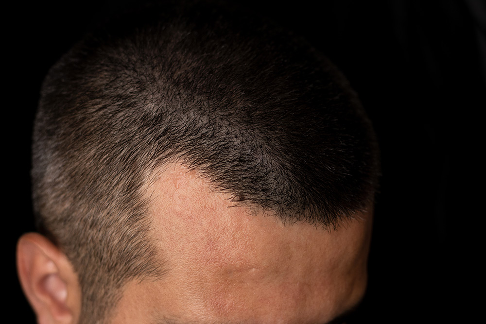 FUE vs DHI | FUE vs DHI Hair Transplant | FUE vs DHI Which is Better | FUE vs DHI Results