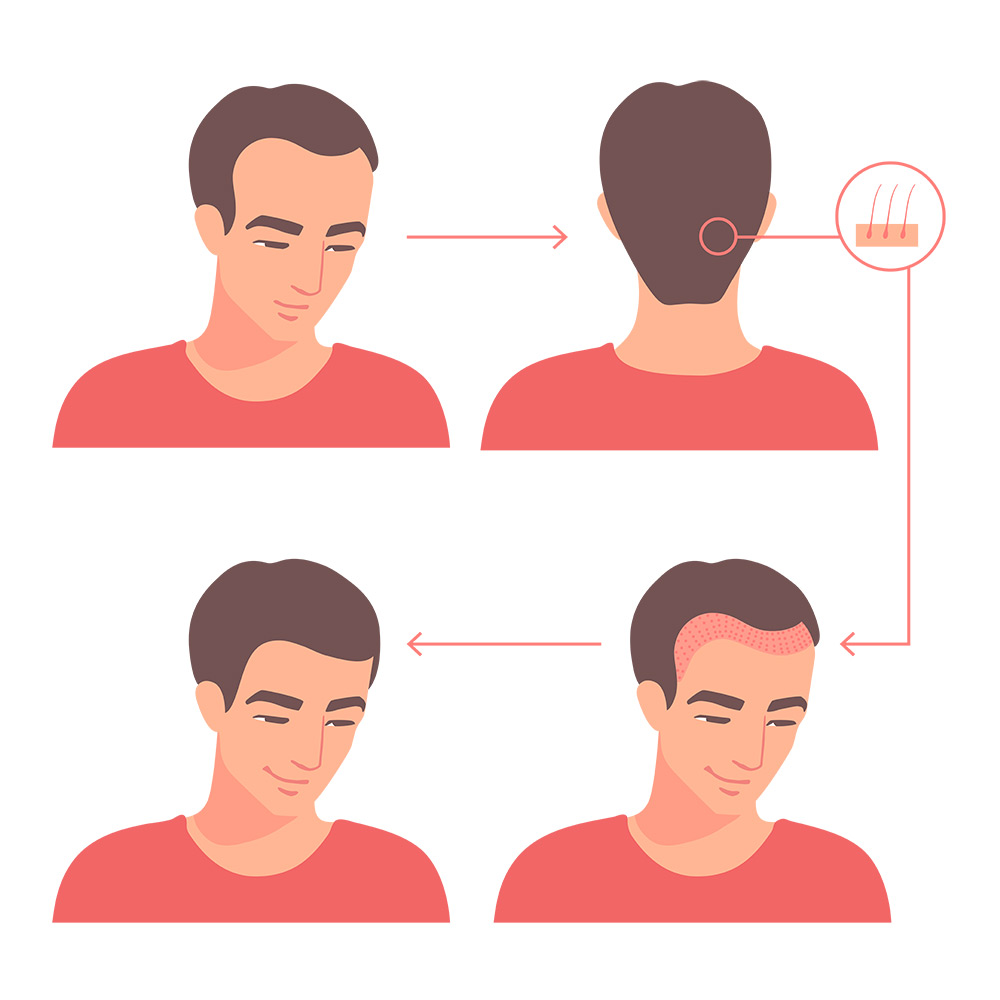 Donor Area Recovery After Hair Transplant | Donor Area Healing After Hair Transplant