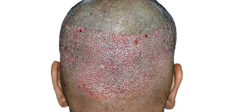 Donor Area Recovery After Hair Transplant | Donor Area Healing After Hair Transplant