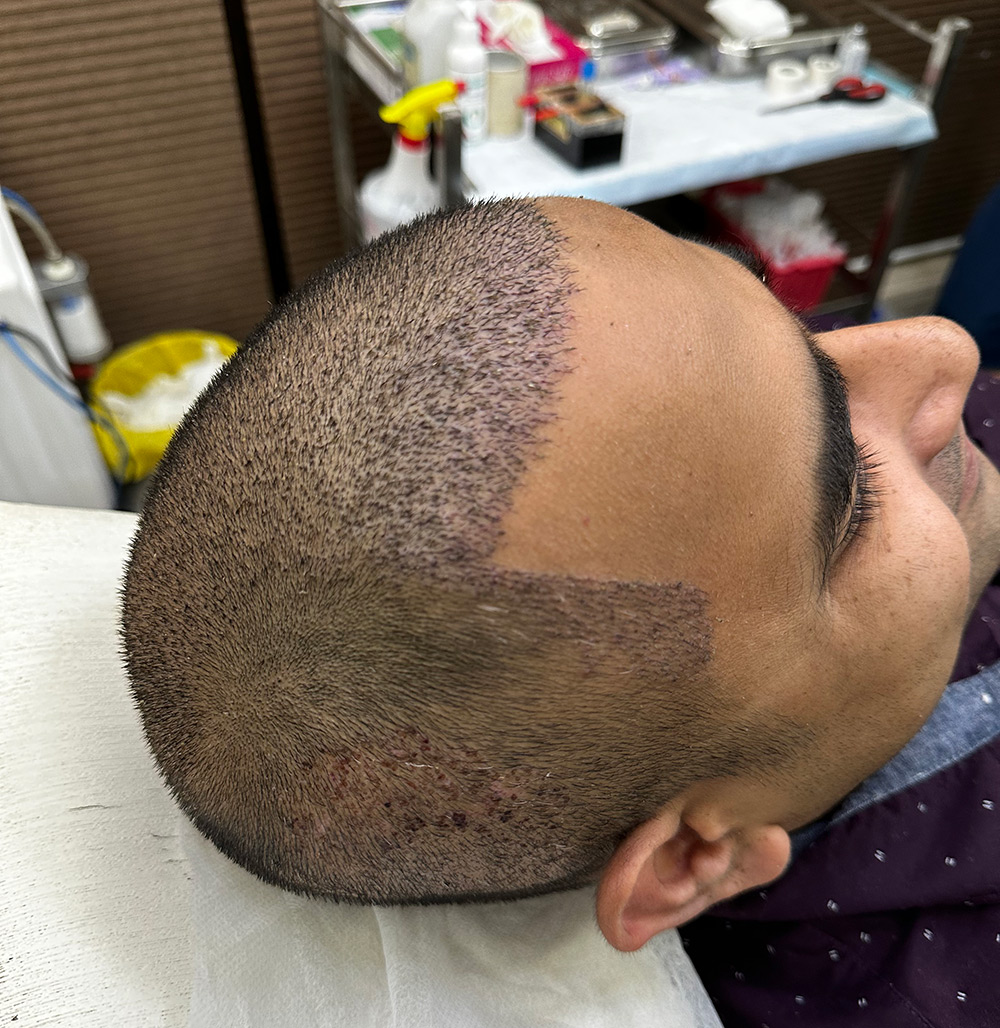 Swelling After Hair Transplant | Tips to Reduce Swelling After Hair Transplant | How Long Does Swelling Last After Hair Transplant