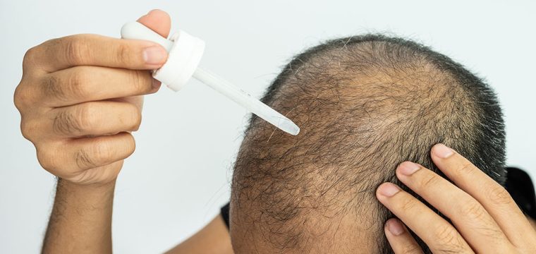 Minoxidil for Hair Growth | Minoxidil for Hair Loss | Is Minoxidil Safe for Hair Growth