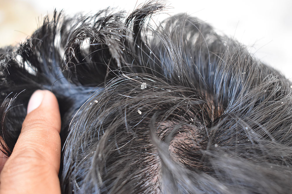 Dry Scalp and Hair Loss | Does Hair Loss From Dry Scalp Grow Back | How Do I Stop Dry Scalp and Hair Loss