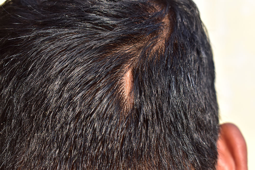 Hair Transplant On Scar | Does Hair Transplant Work on Scars | Can You Regrow Hair Over a Scar?